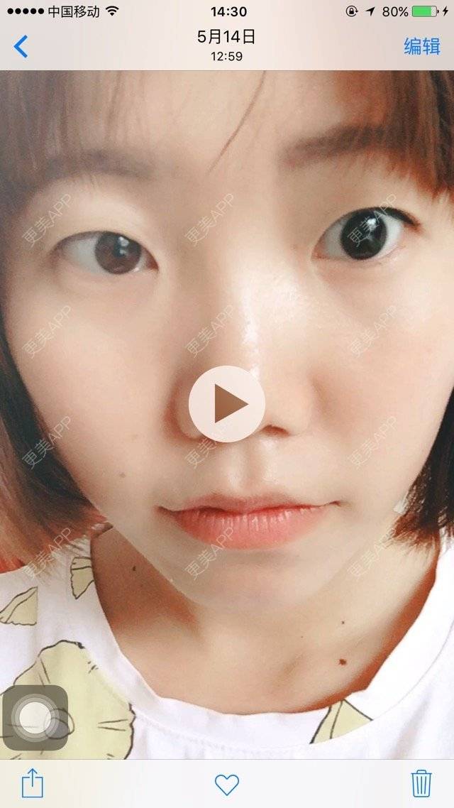更美 - 哪家W菇娘的经验 | 全切双眼皮 | 成都
