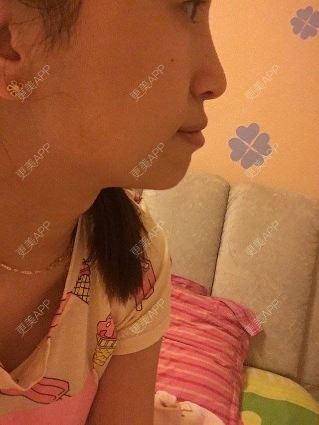 更美 - 衫衫衫阿～的经验 | 假体垫下巴 | 威海