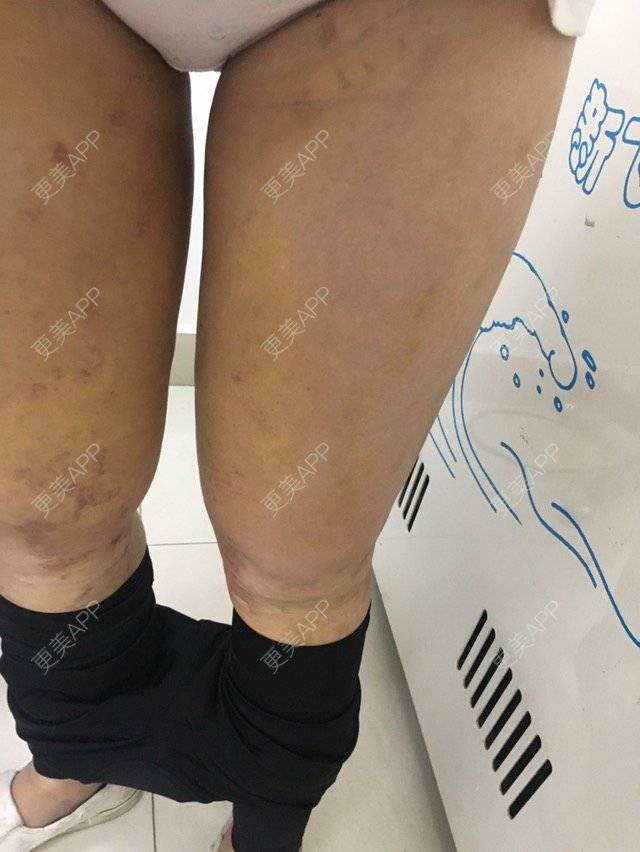 更美 - 大ci小ci的吸脂瘦大腿经验 | 成都 | 吸脂小腿 | 吸脂瘦大腿