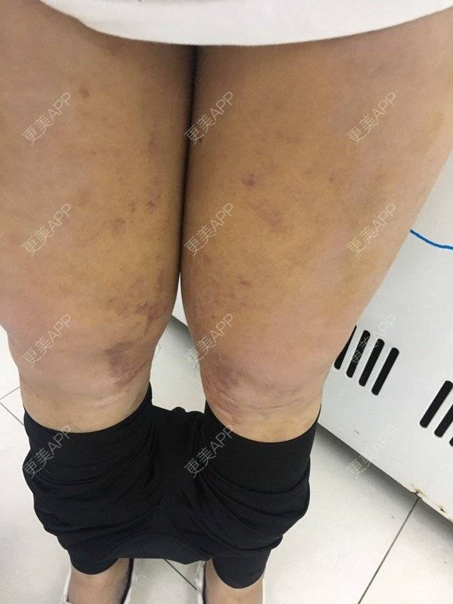 更美 - 大ci小ci的吸脂瘦大腿经验 | 成都 | 吸脂小腿 | 吸脂瘦大腿