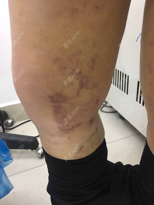 更美 - 大ci小ci的吸脂瘦大腿经验 | 成都 | 吸脂小腿 | 吸脂瘦大腿