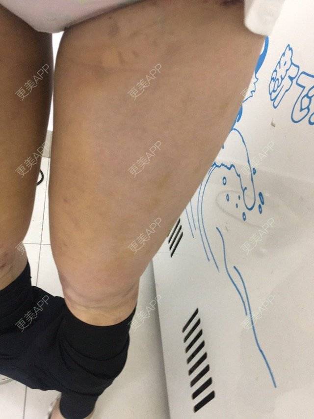 更美 - 大ci小ci的吸脂瘦大腿经验 | 成都 | 吸脂小腿 | 吸脂瘦大腿