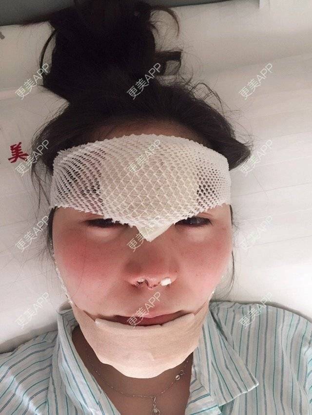 更美 - 小美好好好的经验 | 骨粉取出 | 沈阳 | 缩鼻头鼻翼 | 鼻修复