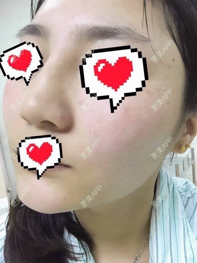更美 - 小美好好好的经验 | 骨粉取出 | 沈阳 | 缩鼻头鼻翼 | 鼻修复