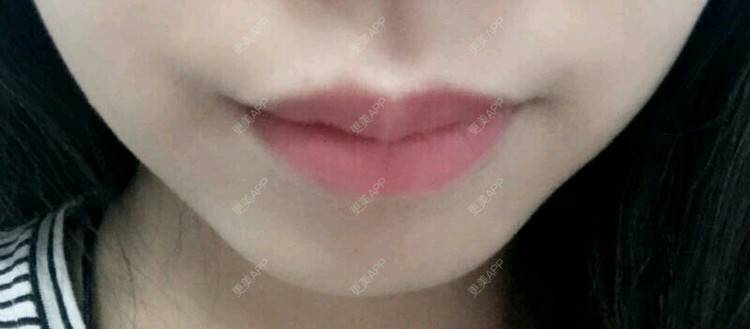 更美 - 小小胡须的脱唇毛经验 | 晒侧颜 | 胡须脱毛 | 深圳 | 脱唇毛