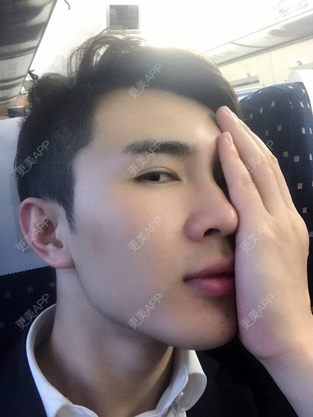 更美 - 笑笑笑水阁的玻尿酸额头经验 | 玻尿酸额头 | 长沙