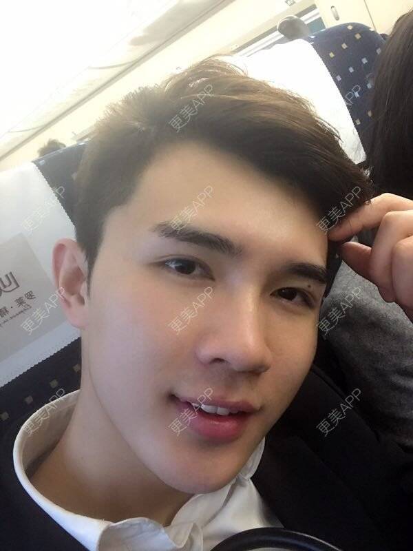 更美 - 笑笑笑水阁的玻尿酸额头经验 | 玻尿酸额头 | 长沙