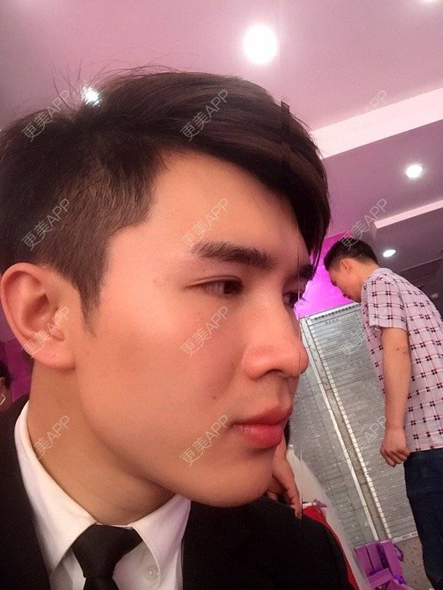 更美 - 笑笑笑水阁的玻尿酸额头经验 | 玻尿酸额头 | 长沙