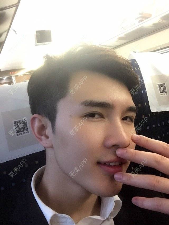 更美 - 笑笑笑水阁的玻尿酸额头经验 | 玻尿酸额头 | 长沙