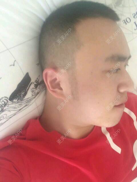 更美 - 王涛 医生的经验 | 耳发 | 鬓角植发 | 成都