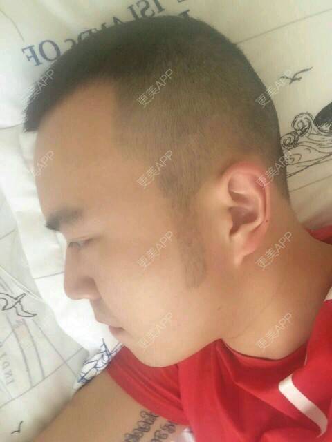 更美 - 王涛 医生的经验 | 耳发 | 鬓角植发 | 成都