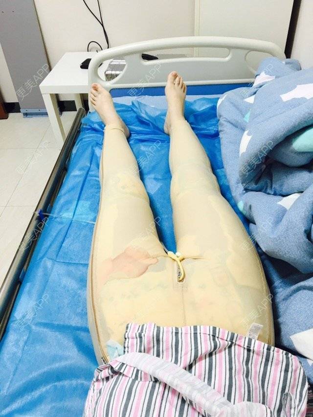 更美 - 巧克力xxx的经验 | 大腿抽脂 | 臀沟吸脂 | 吸脂小腿 | 深圳