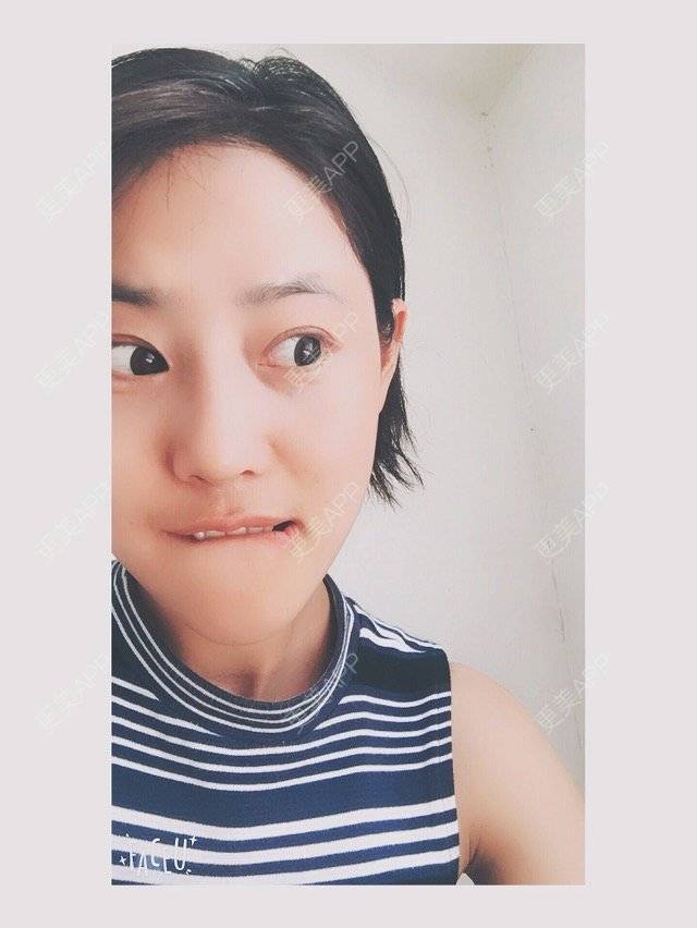 更美 - 隔壁有个小孩的鼻部多项经验 | 硅胶假体隆鼻 | 鼻部多项 | 上海