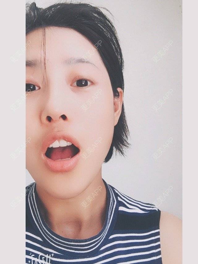 更美 - 隔壁有个小孩的鼻部多项经验 | 硅胶假体隆鼻 | 鼻部多项 | 上海