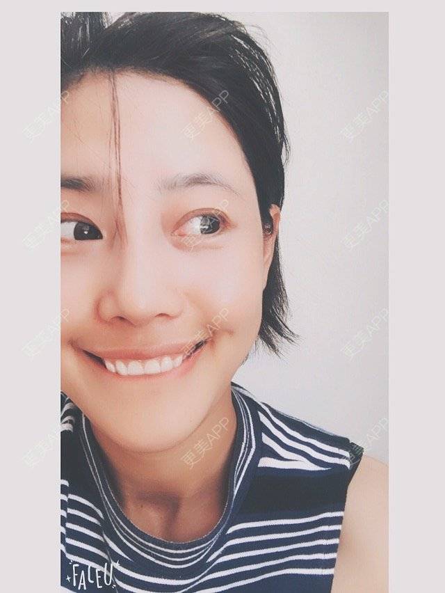 更美 - 隔壁有个小孩的鼻部多项经验 | 硅胶假体隆鼻 | 鼻部多项 | 上海