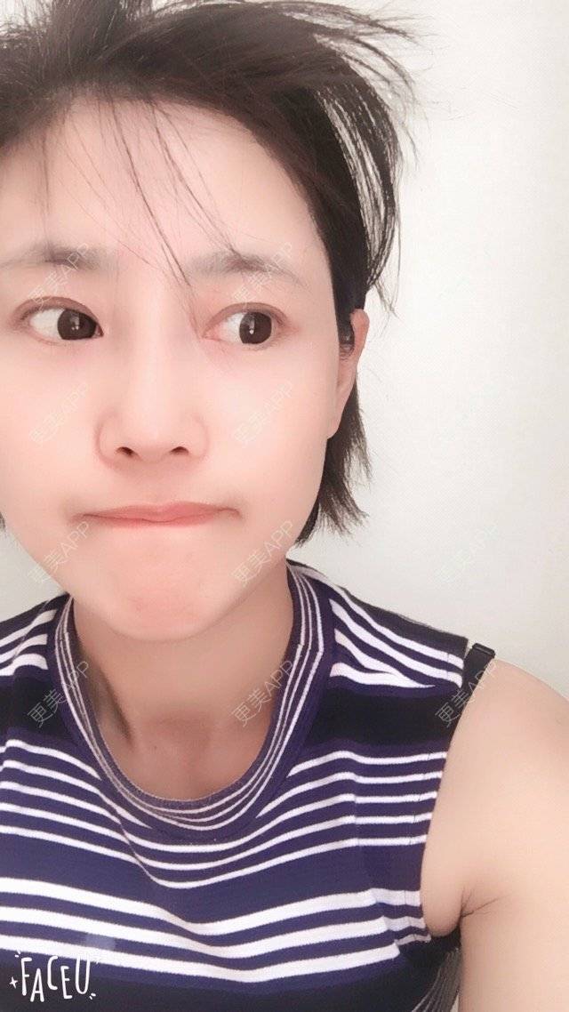 更美 - 隔壁有个小孩的鼻部多项经验 | 硅胶假体隆鼻 | 鼻部多项 | 上海