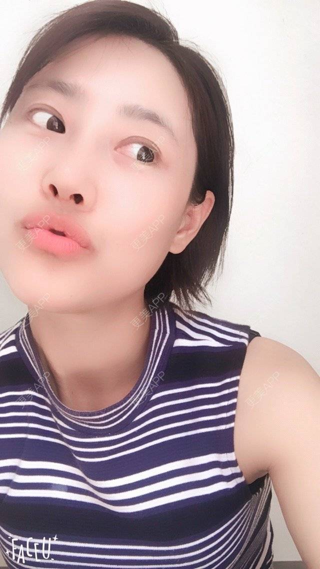 更美 - 隔壁有个小孩的鼻部多项经验 | 硅胶假体隆鼻 | 鼻部多项 | 上海
