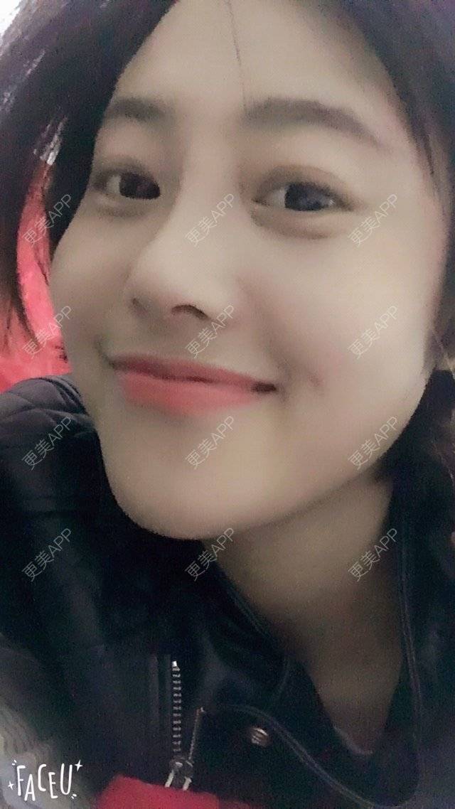 更美 - 隔壁有个小孩的鼻部多项经验 | 硅胶假体隆鼻 | 鼻部多项 | 上海