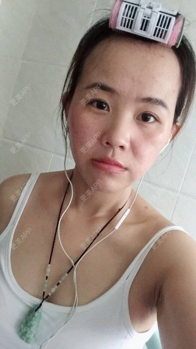 更美 - BB喜的经验 | 正颌术 | 牙齿正畸 | 地包天 | 深圳