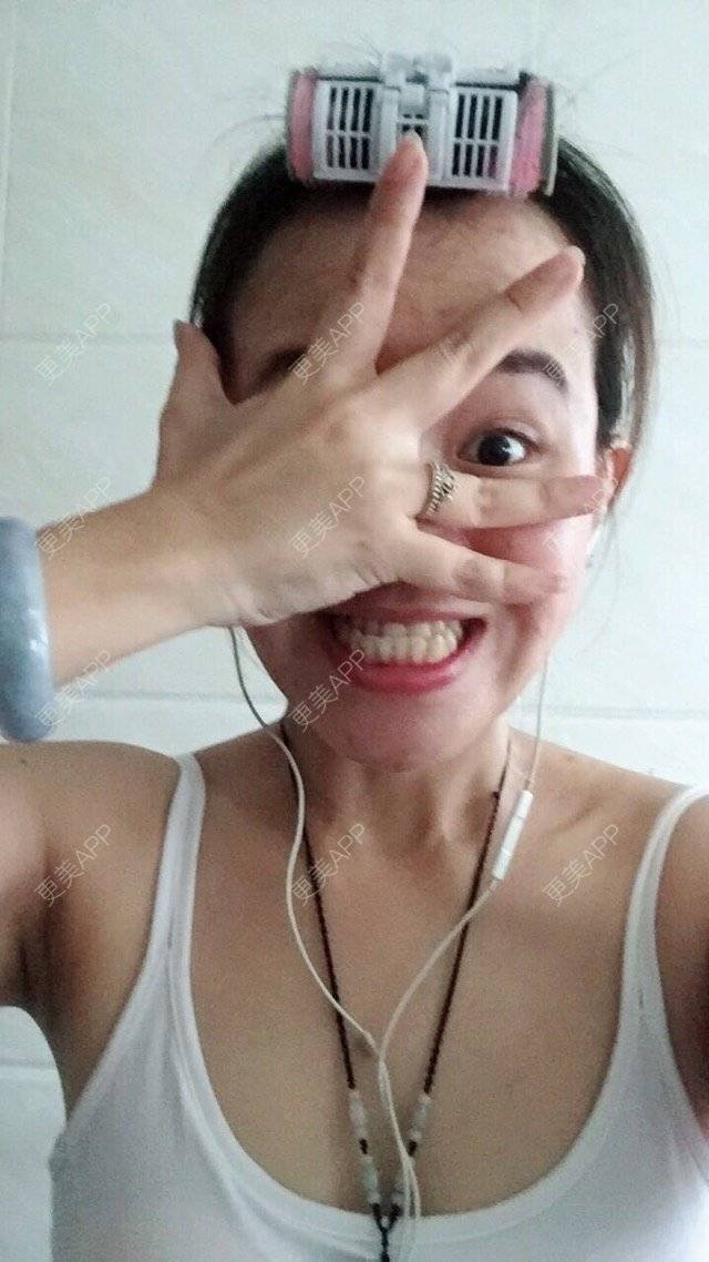 更美 - BB喜的经验 | 正颌术 | 牙齿正畸 | 地包天 | 深圳