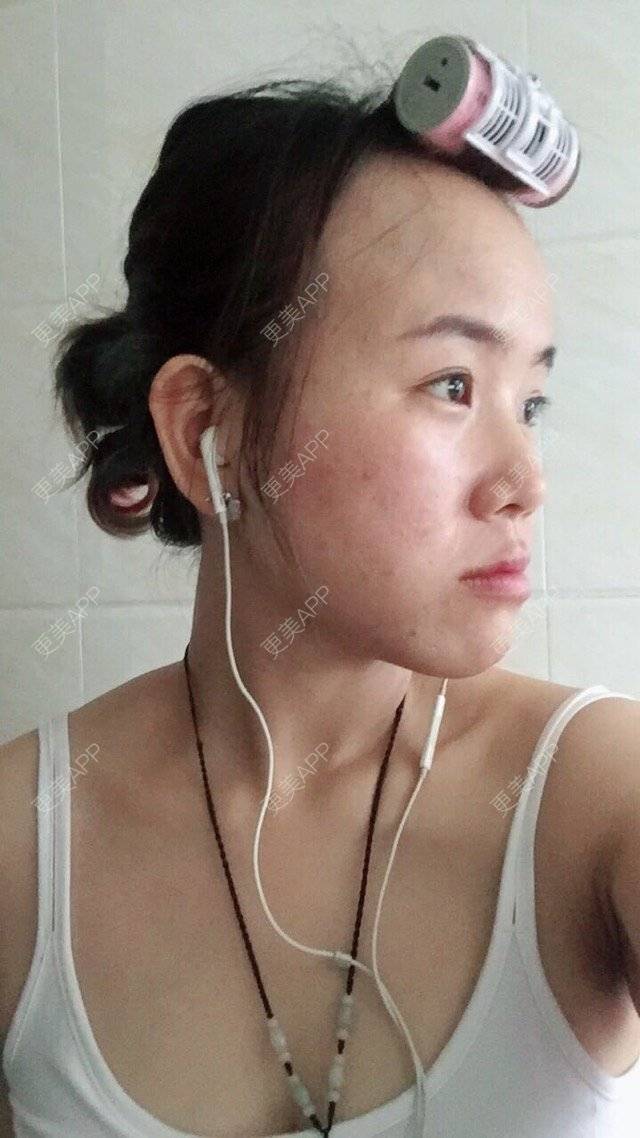 更美 - BB喜的经验 | 正颌术 | 牙齿正畸 | 地包天 | 深圳