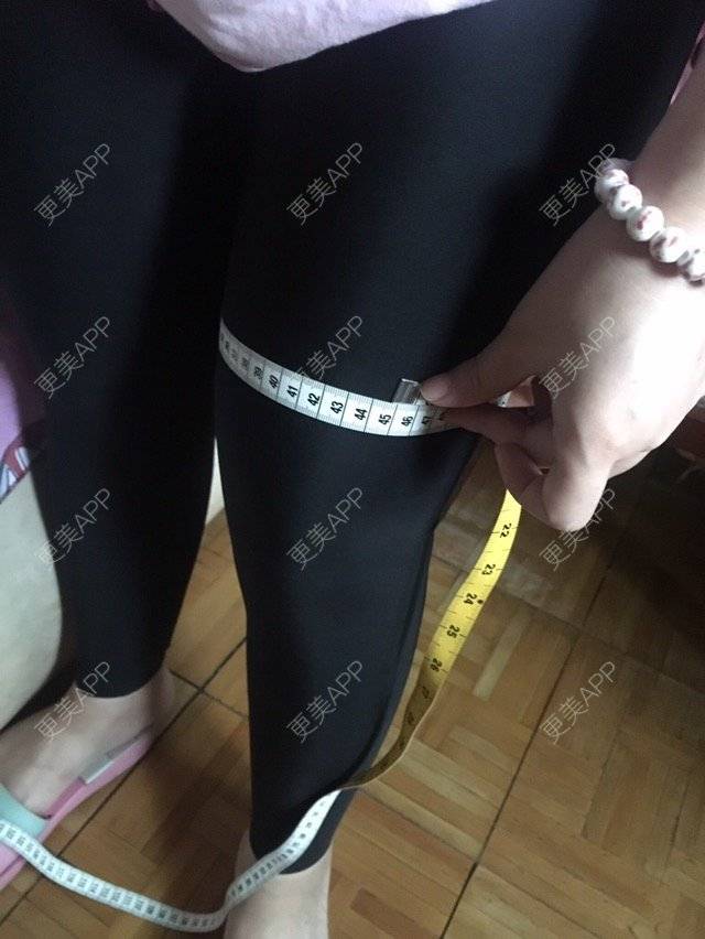 更美 - 大ci小ci的吸脂瘦大腿经验 | 成都 | 吸脂小腿 | 吸脂瘦大腿