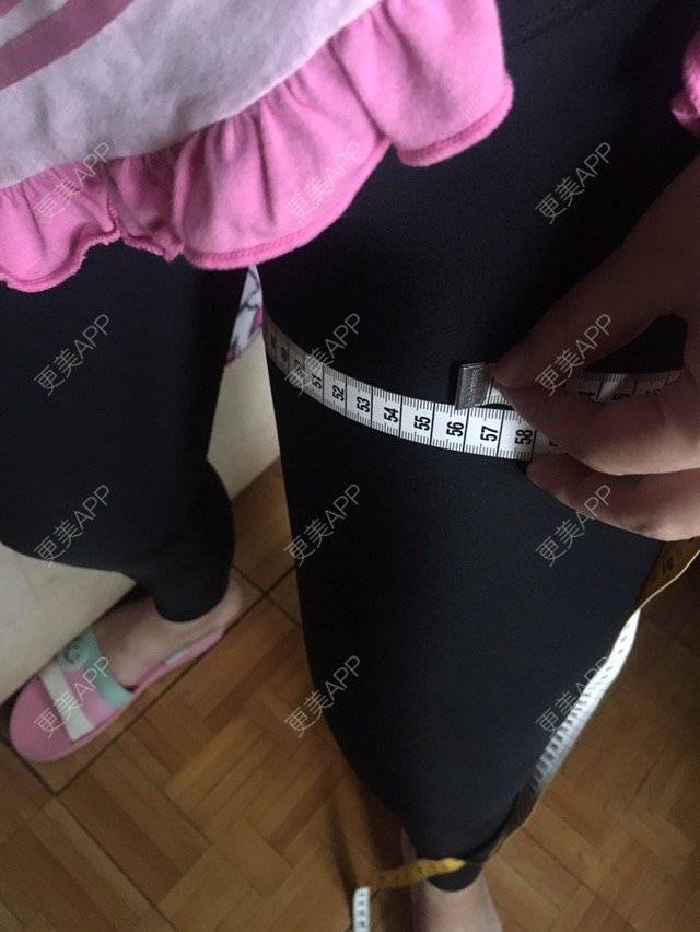 更美 - 大ci小ci的吸脂瘦大腿经验 | 成都 | 吸脂小腿 | 吸脂瘦大腿