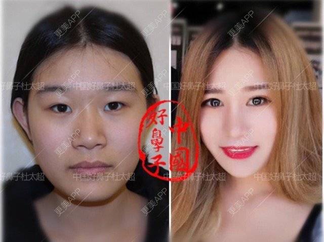 更美 - 杜太超 医生的经验 | 耳软骨鼻尖 | 隆鼻 | 鼻部多项 | 北京