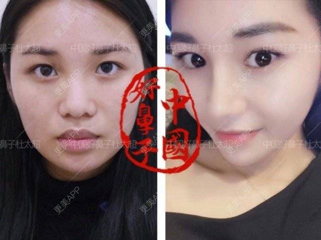 更美 - 杜太超 医生的经验 | 耳软骨鼻尖 | 隆鼻 | 鼻部多项 | 北京