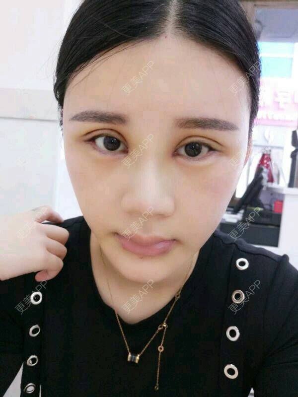 更美 - 完美主义😘的双眼皮经验 | 还好整了它 | 深圳 | 双眼皮 | 彩光祛斑
