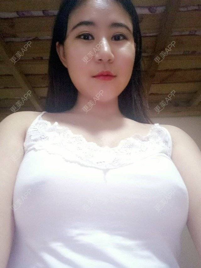 更美 - 我想你爱我的自体脂肪隆胸经验 | 自体脂肪隆胸 | 丰胸（隆胸） | 隆胸 | 重庆