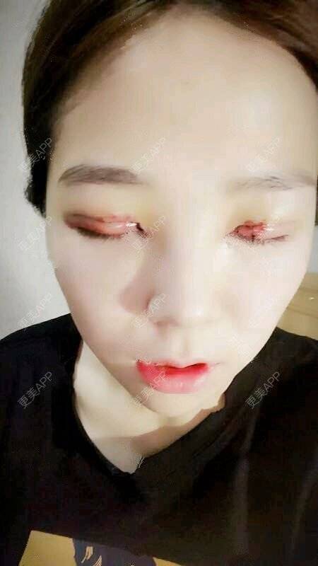 马念访瑾凉的全切双眼皮日记