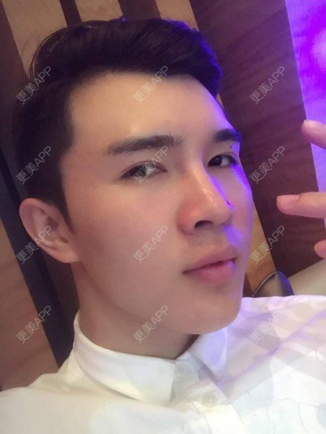 更美 - 笑笑笑水阁的玻尿酸额头经验 | 玻尿酸额头 | 长沙