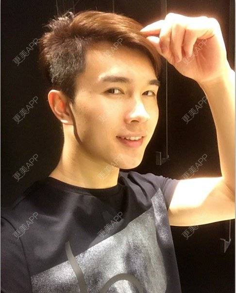 更美 - 笑笑笑水阁的玻尿酸额头经验 | 玻尿酸额头 | 长沙