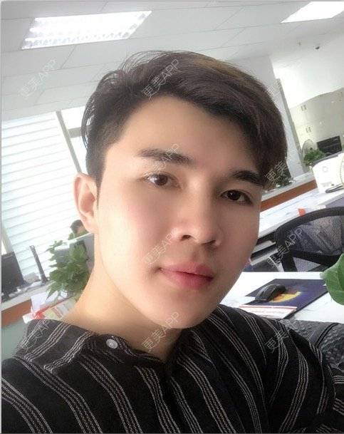 更美 - 笑笑笑水阁的玻尿酸额头经验 | 玻尿酸额头 | 长沙