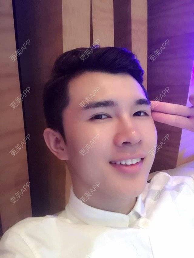 更美 - 笑笑笑水阁的玻尿酸额头经验 | 玻尿酸额头 | 长沙