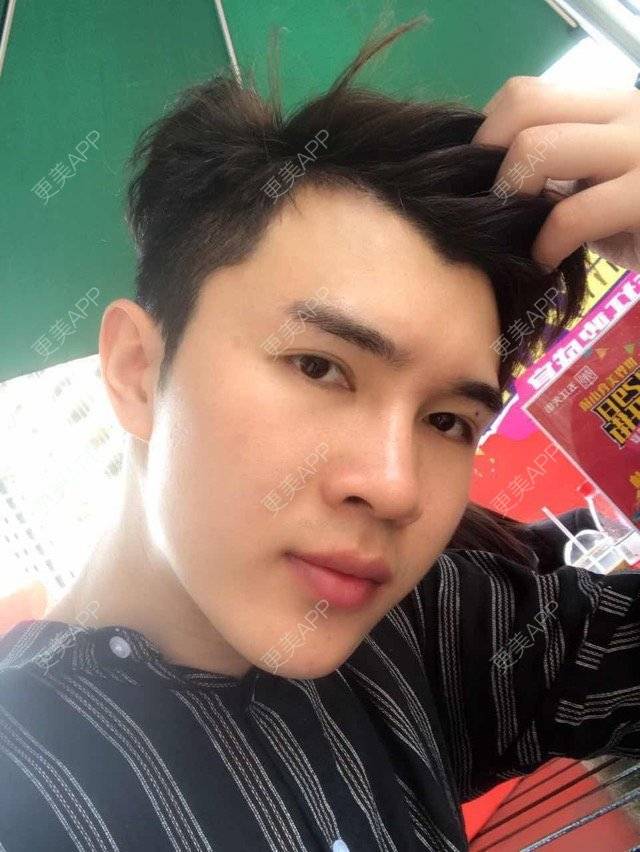 更美 - 笑笑笑水阁的玻尿酸额头经验 | 玻尿酸额头 | 长沙