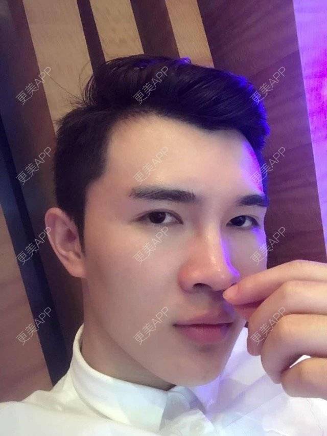 更美 - 笑笑笑水阁的玻尿酸额头经验 | 玻尿酸额头 | 长沙