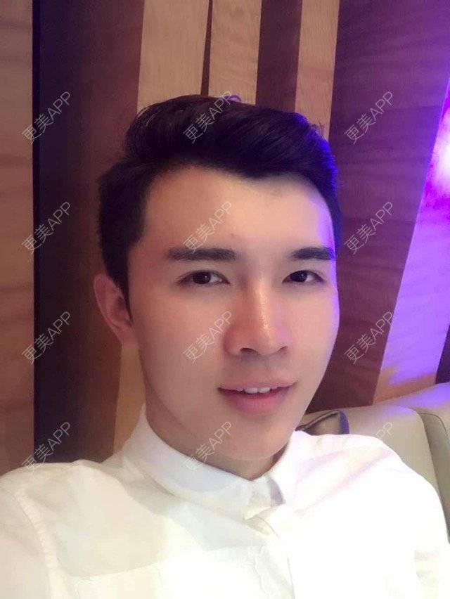 更美 - 笑笑笑水阁的玻尿酸额头经验 | 玻尿酸额头 | 长沙