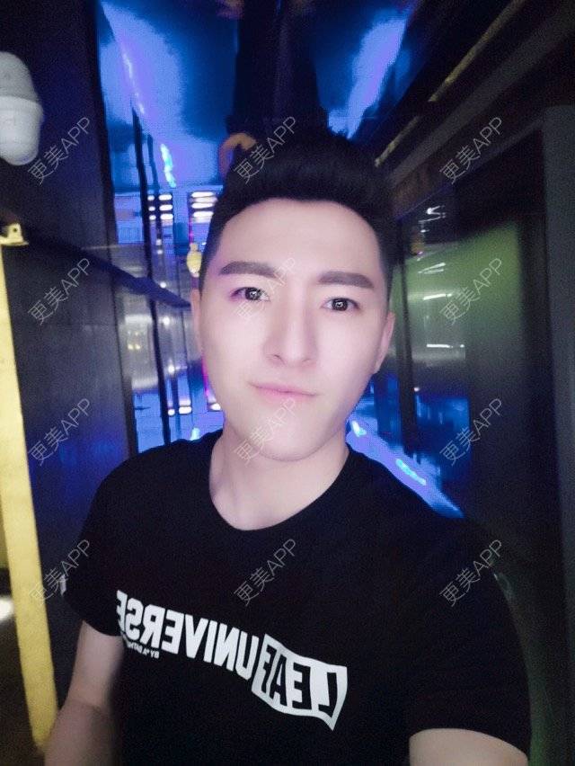 更美 - 柳安花明又一村的玻尿酸额头经验 | 长沙 | 玻尿酸额头