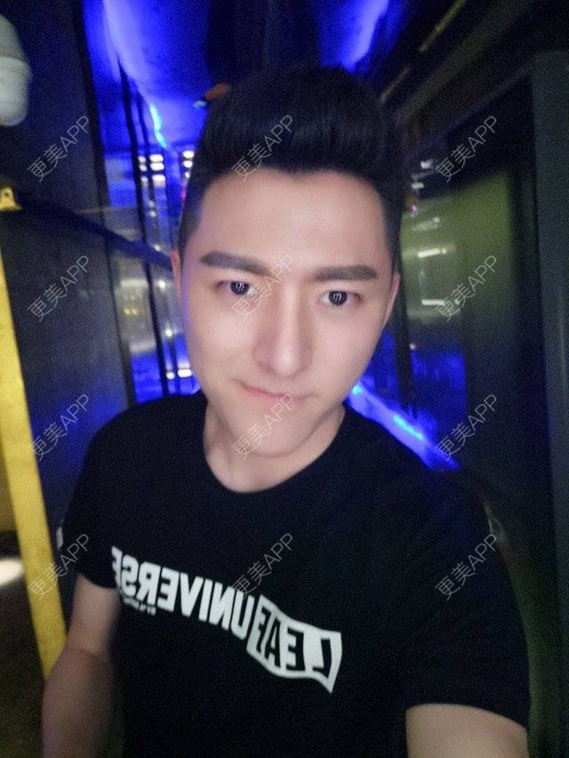 更美 - 柳安花明又一村的玻尿酸额头经验 | 长沙 | 玻尿酸额头