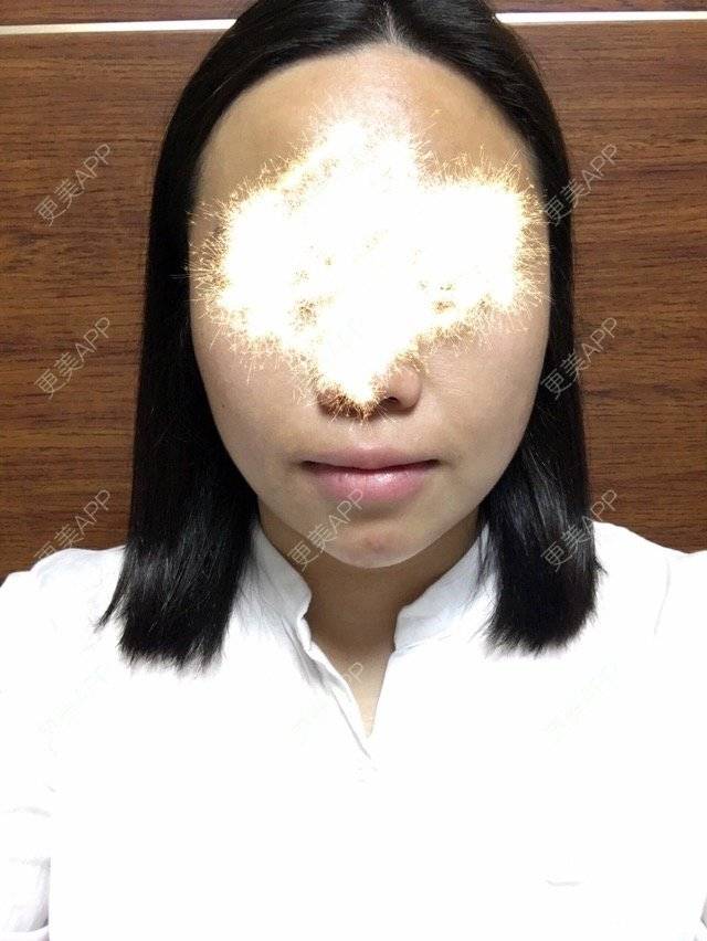 更美 - ROU_rou的注射美白经验 | 土豪溶脂针 | 注射美白 | 清远
