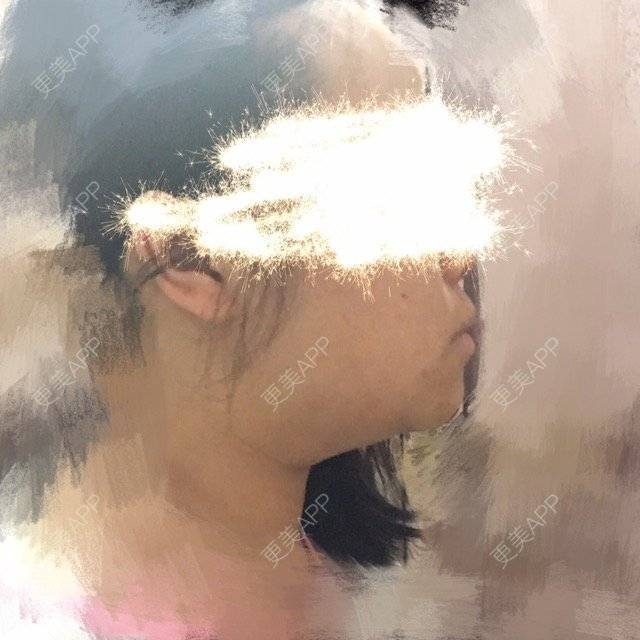 更美 - ROU_rou的注射美白经验 | 土豪溶脂针 | 注射美白 | 清远