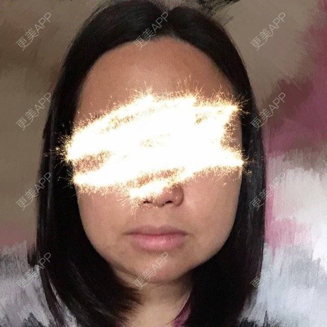 更美 - ROU_rou的注射美白经验 | 土豪溶脂针 | 注射美白 | 清远