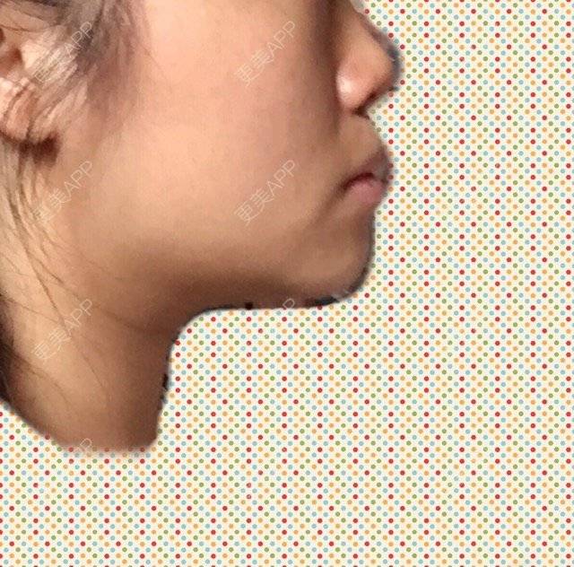 更美 - ROU_rou的注射美白经验 | 土豪溶脂针 | 注射美白 | 清远