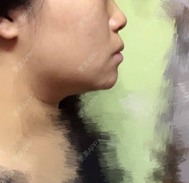 更美 - ROU_rou的注射美白经验 | 土豪溶脂针 | 注射美白 | 清远