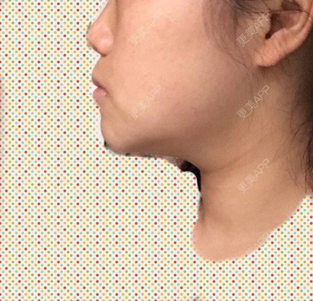 更美 - ROU_rou的注射美白经验 | 土豪溶脂针 | 注射美白 | 清远