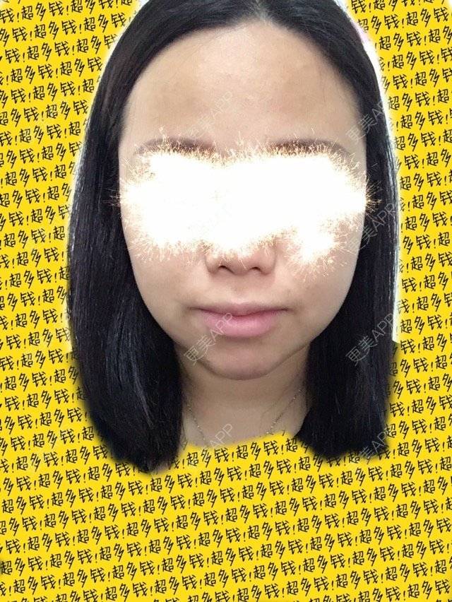 更美 - ROU_rou的注射美白经验 | 土豪溶脂针 | 注射美白 | 清远