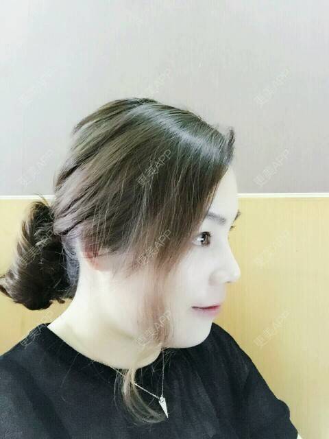 更美 - 小明不再是小明的全切双眼皮经验 | 切开割双眼皮 | 深圳 | 全切双眼皮 | 全切开双眼皮