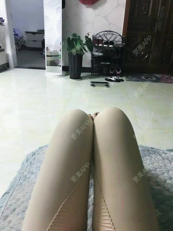更美 - 花无舞的吸脂经验 | 吸脂瘦大腿1 | 大腿吸脂修复 | 吸脂 | 深圳